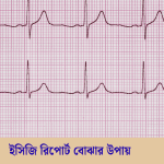 ইসিজি রিপোর্ট বোঝার উপায়
