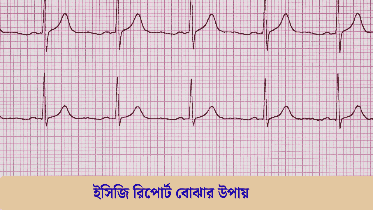 ইসিজি রিপোর্ট বোঝার উপায়: ECG রিপোর্টের বিভিন্ন অংশ সহজে বুঝুন