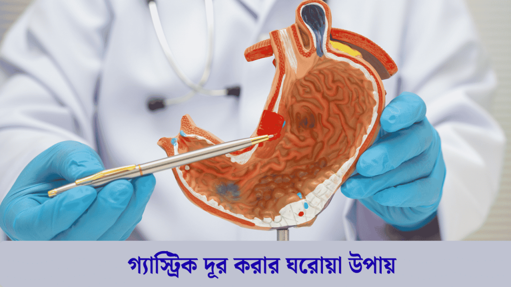 গ্যাস্ট্রিক দূর করার ঘরোয়া উপায়
