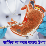 গ্যাস্ট্রিক দূর করার ঘরোয়া উপায়